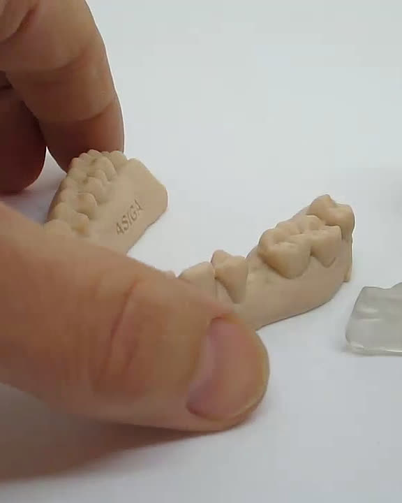A 3D-printed implant surgical guide being fitted onto a dental model.